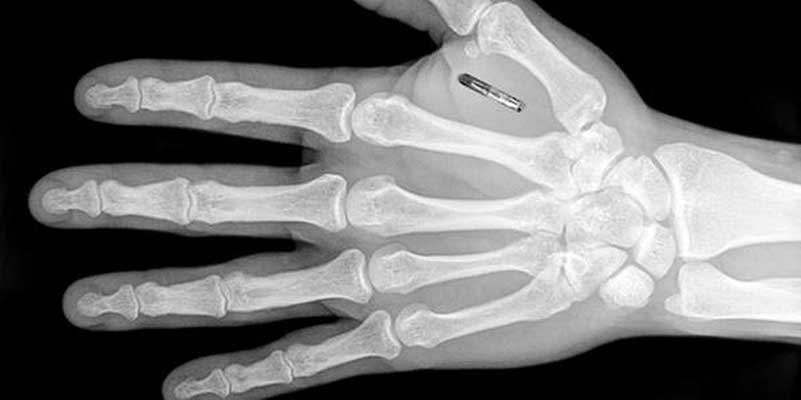 Röntgenfoto van hand met microchip implantaat