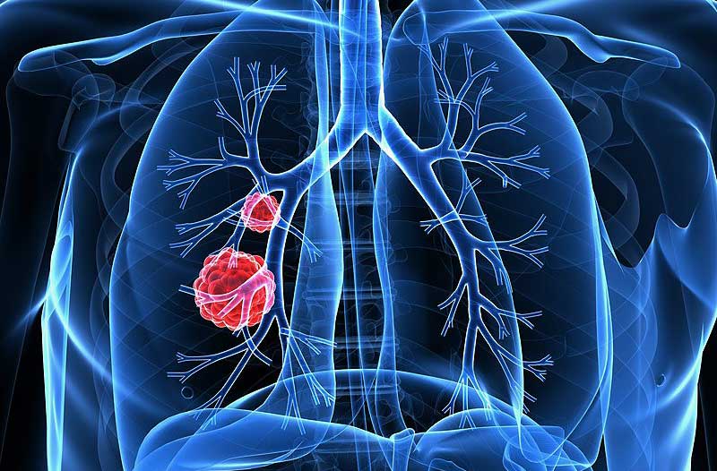 3D-illustratie van menselijke longen met rode tumoren