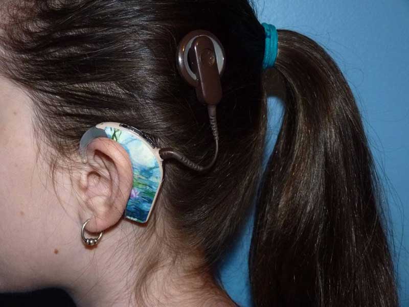 A side view of a girl wearing a cochlear implant