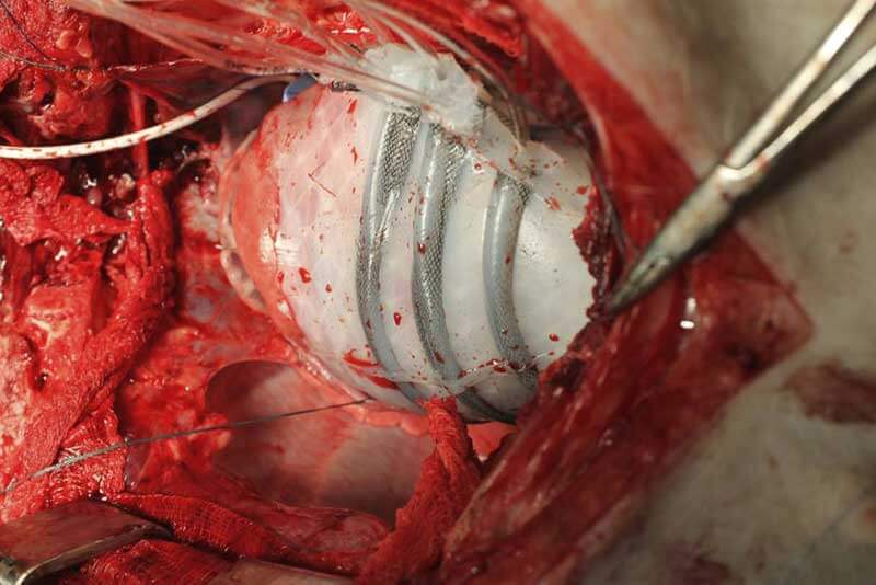 A white material with tubes surrounding a heart pumping blood to it during surgery