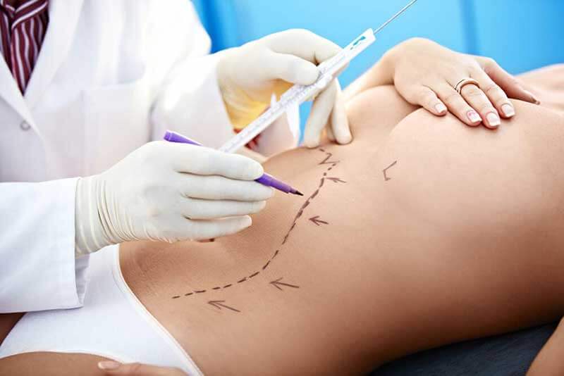 A doctor drawing lines on a woman’s stomach in preparation for plastic surgery